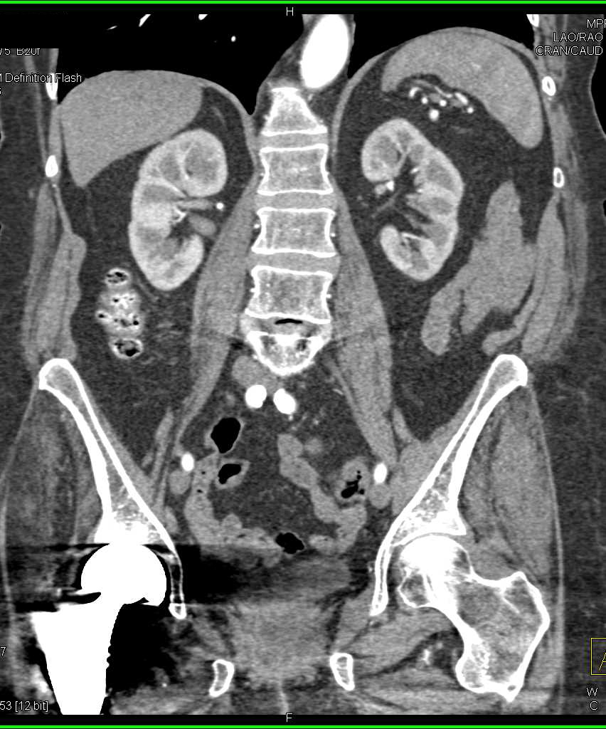 Subtle Transitional Cell Carcinoma (TCC) Right Renal Pelvis - CTisus CT Scan