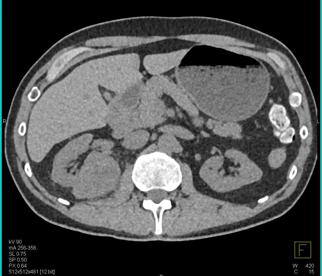 Clear Cell Renal Cell Carcinoma - CTisus CT Scan