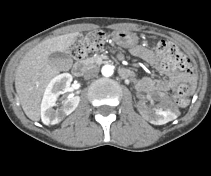 Renal Lymphoma - CTisus CT Scan
