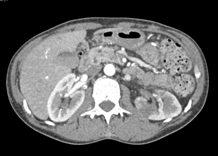 Renal Lymphoma - CTisus CT Scan