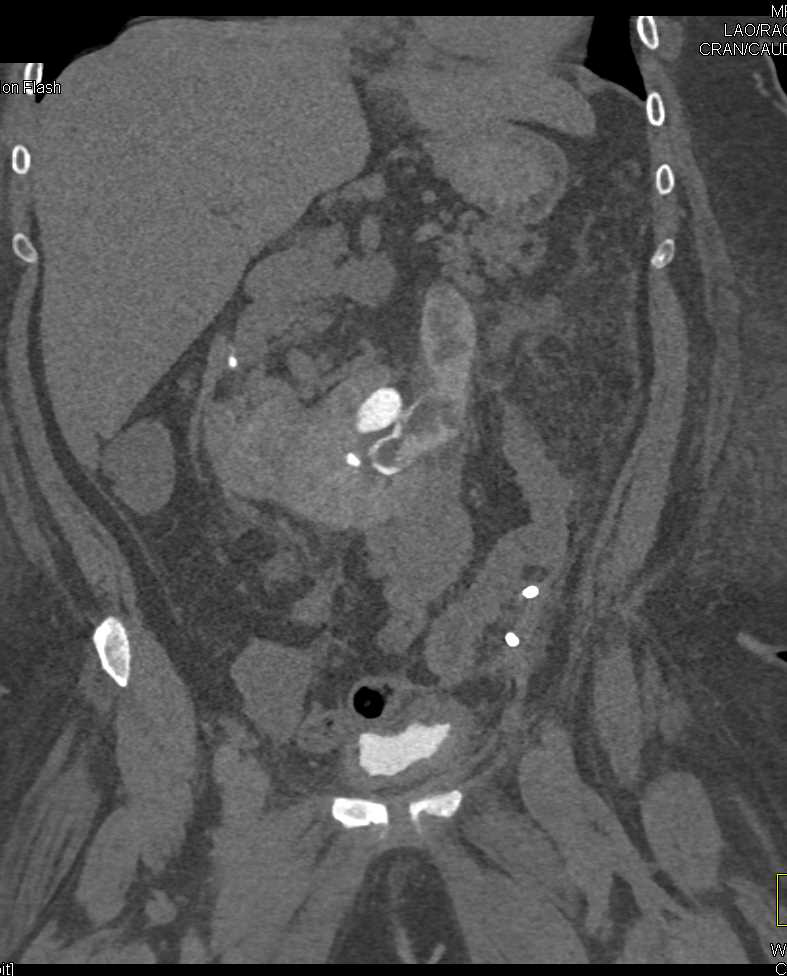 Blood Clots in Calyceas - CTisus CT Scan