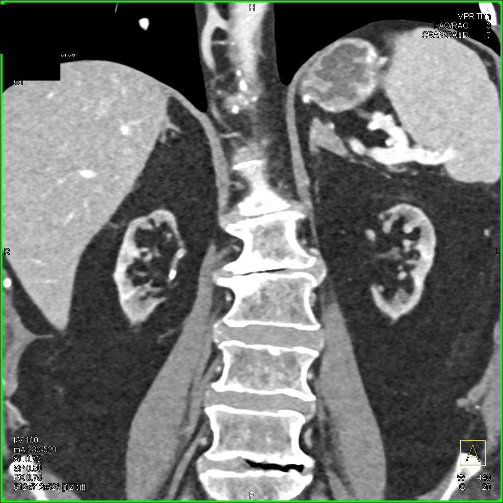 End Stage Renal Disease - CTisus CT Scan