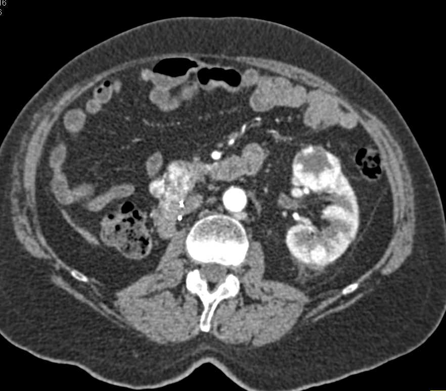 Metastatic Renal Cell Carcinoma to the Pancreas and Contralateral Kidney - CTisus CT Scan