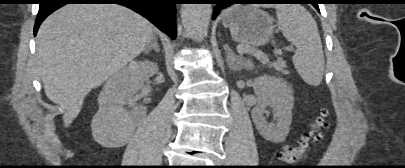 High Density Renal Cyst - CTisus CT Scan