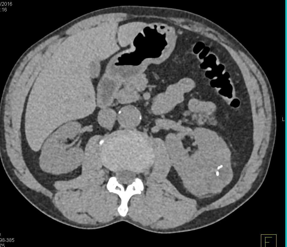 Papillary Left Renal Cell Carcinoma - CTisus CT Scan