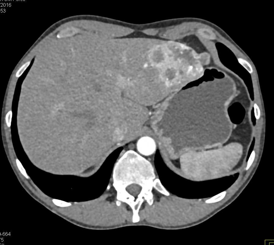 Metastatic Renal Cell Carcinoma - CTisus CT Scan