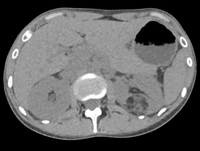 Angiomyolipoma Left Kidney - CTisus CT Scan