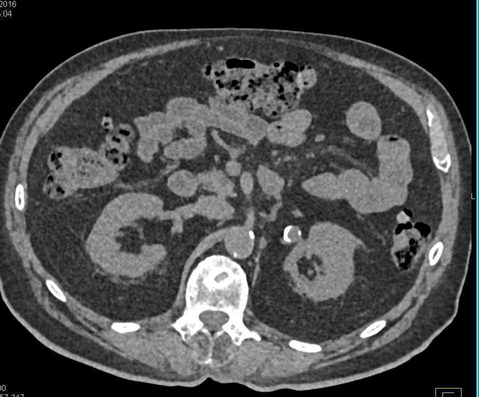 Left Renal Artery Aneurysm - CTisus CT Scan