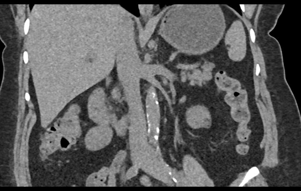 1cm Renal Cell Carcinoma - CTisus CT Scan