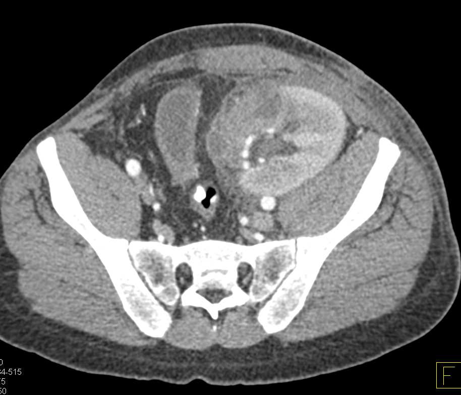 Acute Pyelonephritis in a Transplant Kidney - CTisus CT Scan