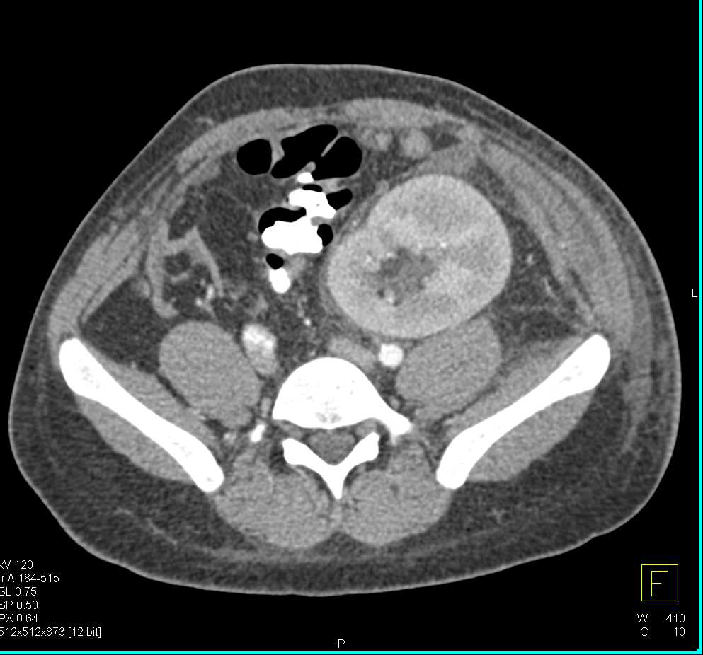 Acute Pyelonephritis in a Transplant Kidney - CTisus CT Scan