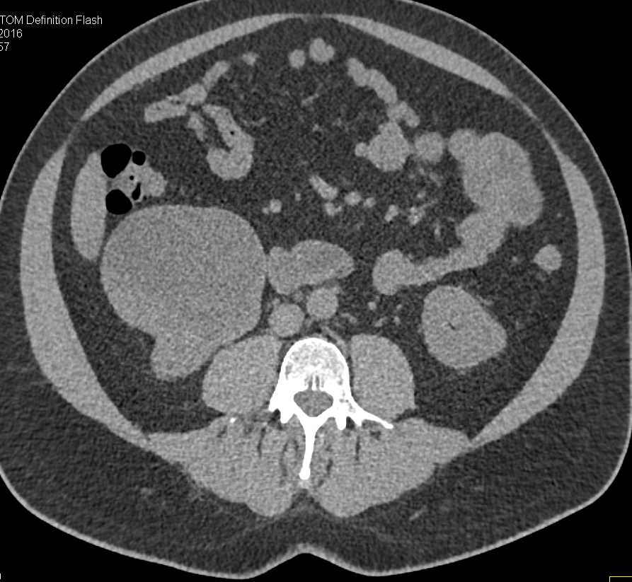 Bosniak 2F Cyst Right Kidney - CTisus CT Scan