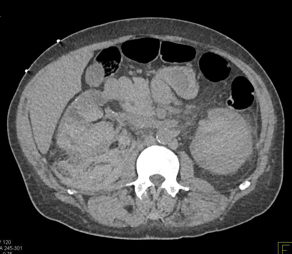 Bilateral Renal Bleeds Especially in the Right Kidney - CTisus CT Scan