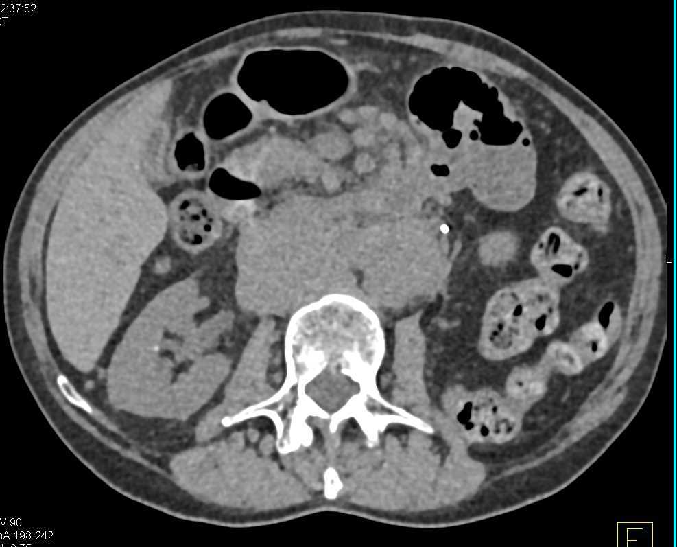 Metastatic Renal Cell Carcinoma to the Pancreas and Adenopathy - CTisus CT Scan