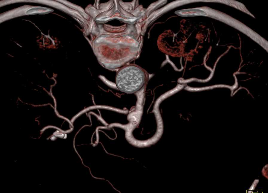 Right Renal Artery Aneurysm and Accessory Right Hepatic Artery - CTisus CT Scan