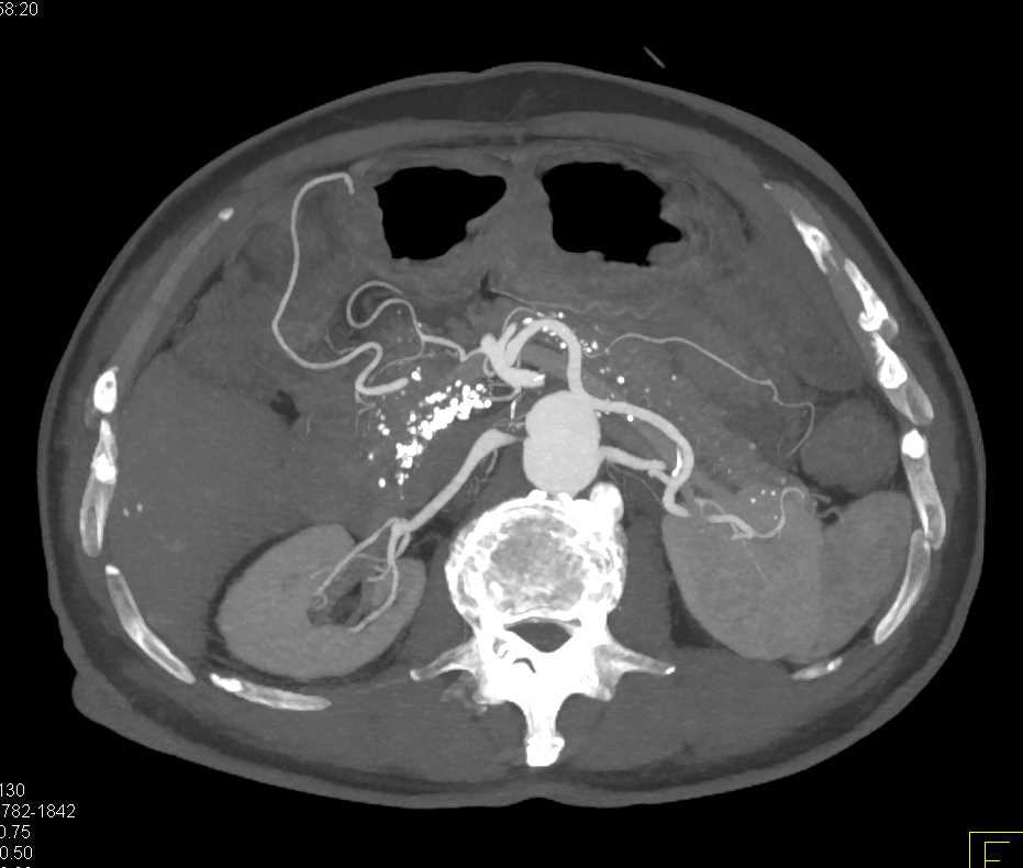 Renal Artery Stenosis - CTisus CT Scan