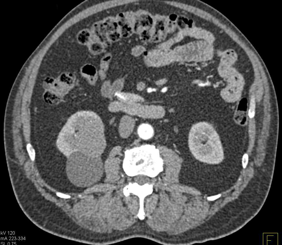 Complex Renal Cyst - CTisus CT Scan