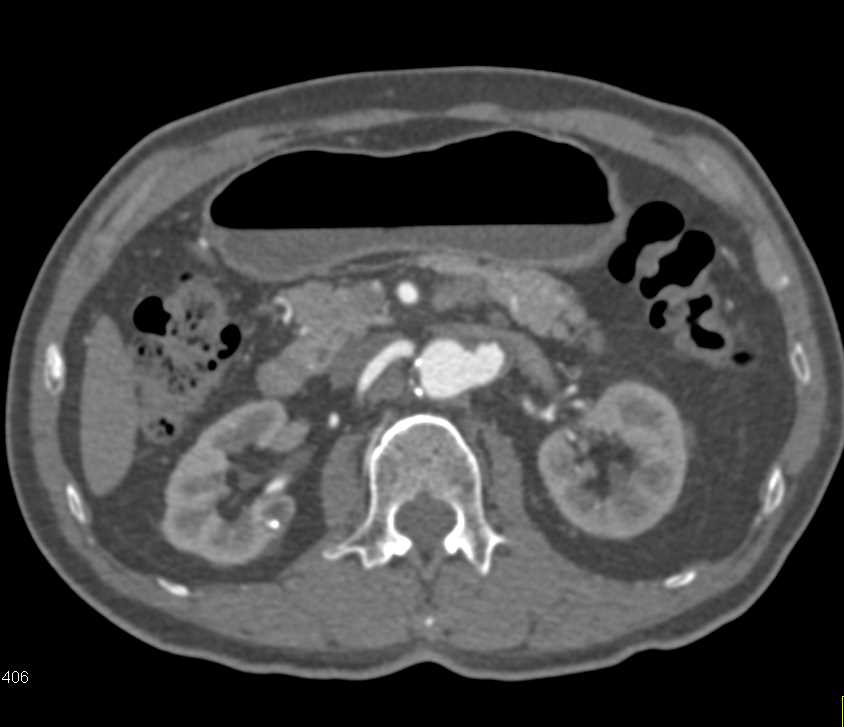 Left Renal Artery Aneurysm - CTisus CT Scan