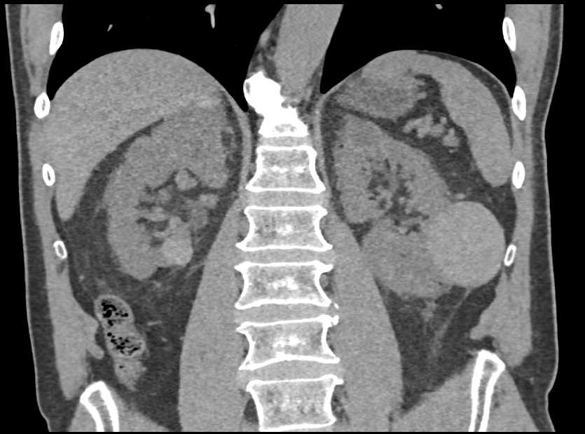 High Density Renal Cysts - CTisus CT Scan