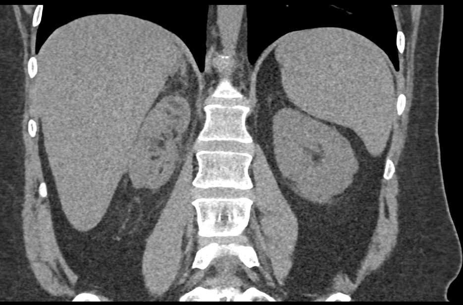 Acute and Chronic Pyelonephritis Right Kidney - CTisus CT Scan