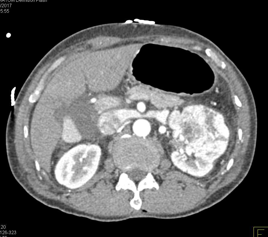Clear Cell Renal Cell Carcinoma - CTisus CT Scan