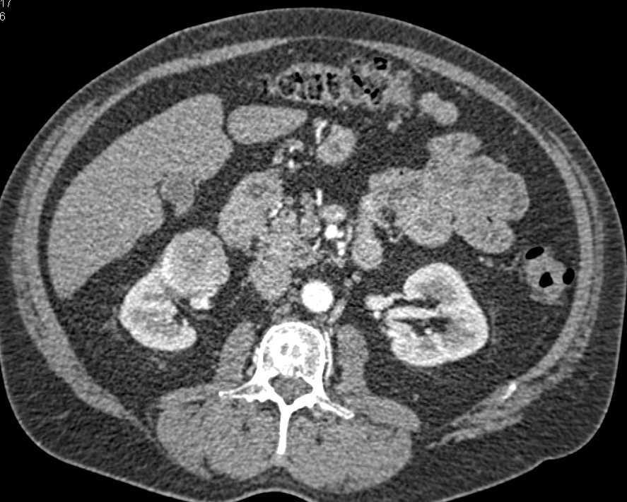 Renal Cell Carcinoma with Bone Metastases - CTisus CT Scan