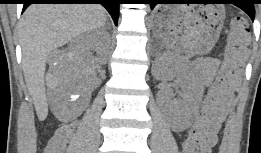 Renal Cell Carcinoma Right Kidney with Dystrophic Calcification - CTisus CT Scan