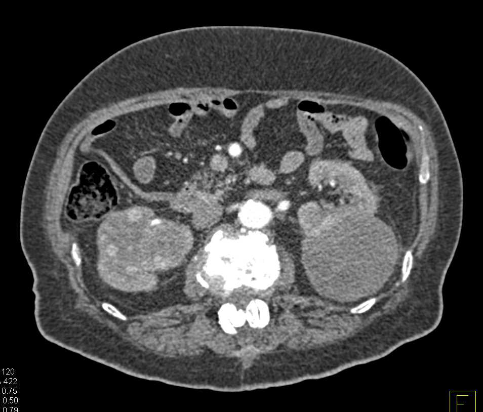Bilateral Renal Cell Carcinoma - CTisus CT Scan