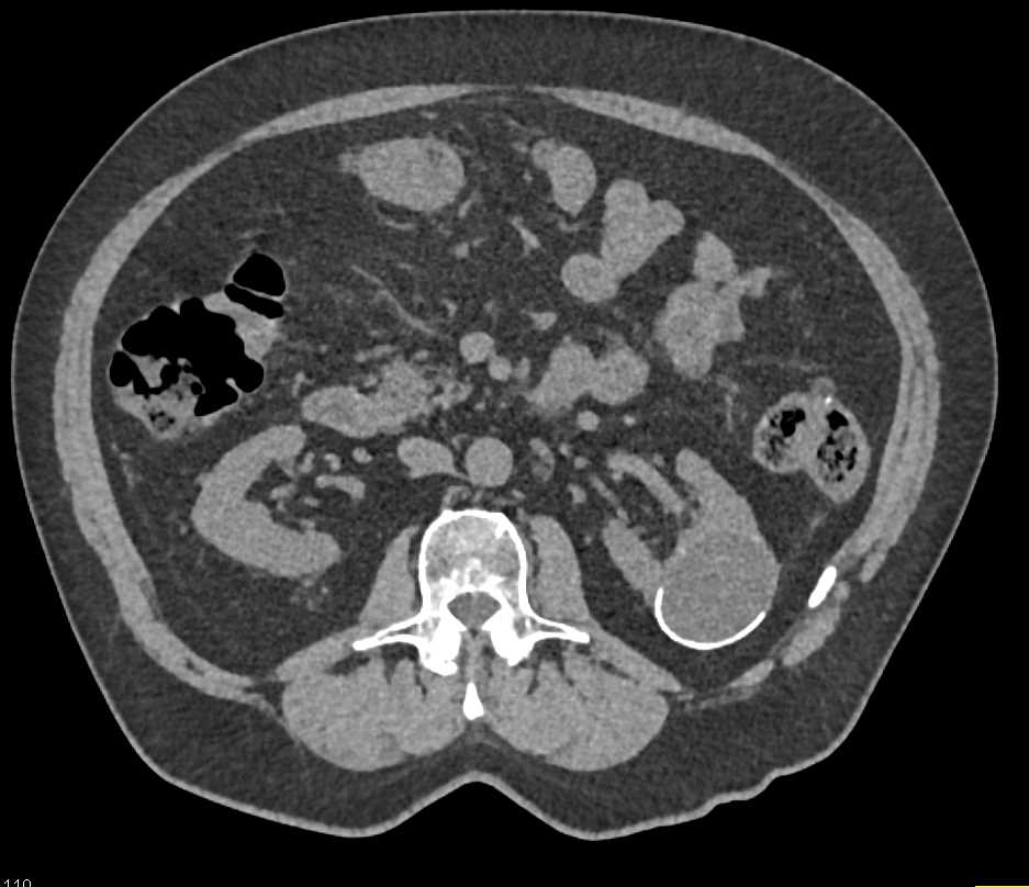 Bosniak 2 Cyst Left Kidney - CTisus CT Scan