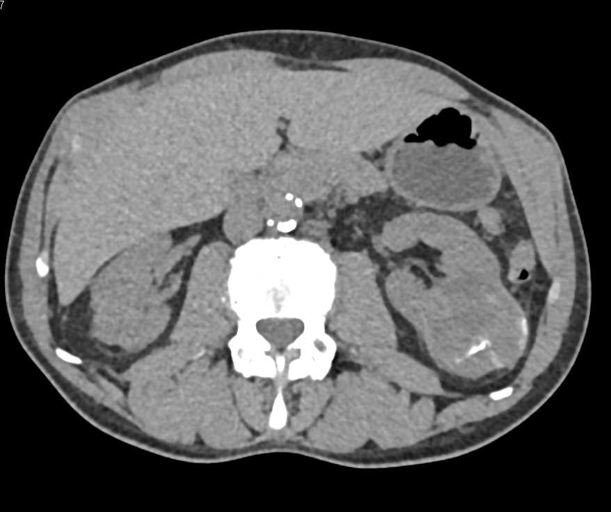 Dystrophic Calcification in a Left Renal Cell Carcinoma - CTisus CT Scan