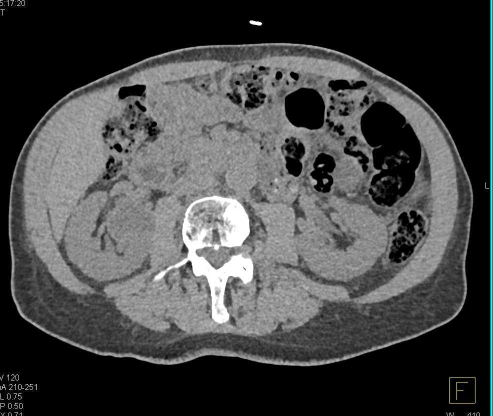 Parapelvic Cyst Right Kidney and Enlarged Prostate - CTisus CT Scan