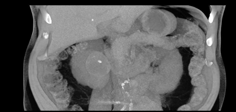 Bosniak 2F Cyst Right Kidney - CTisus CT Scan