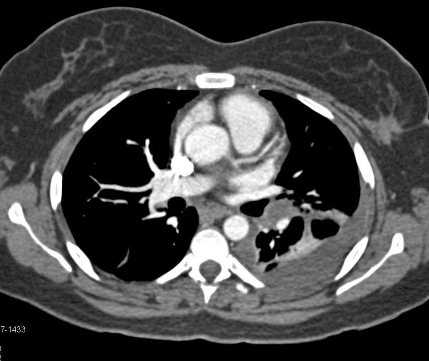Transitional Cell Carcinoma (TCC) Right Kidney - CTisus CT Scan