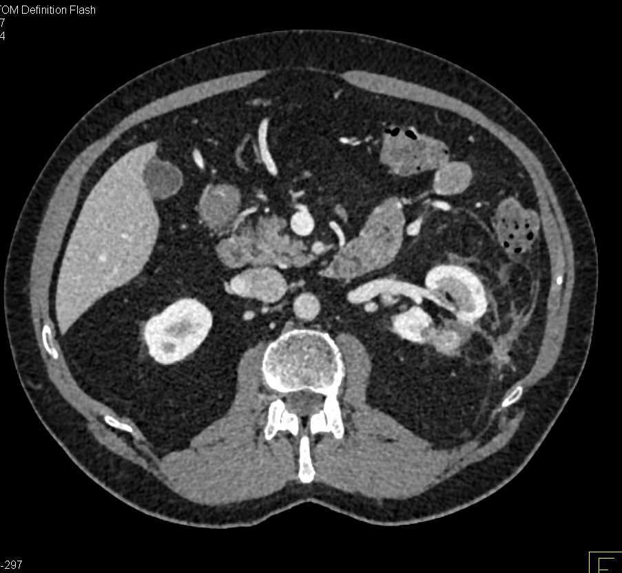 Partial Left Nephrectomy with Pseudoaneurysm Left Kidney - CTisus CT Scan