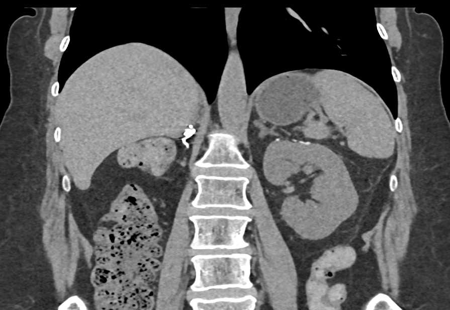 2cm Clear Cell Renal Cell carcinoma Left Kidney in Patient with Prior Nephrectomy - CTisus CT Scan