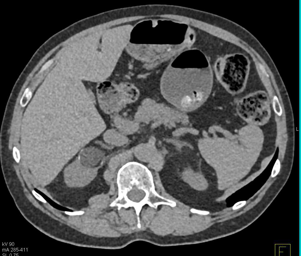 Transitional Cell Carcinoma (TCC) Right Kidney - CTisus CT Scan