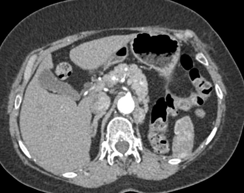 Metastatic Renal Cell Carcinoma to the Pancreas - CTisus CT Scan