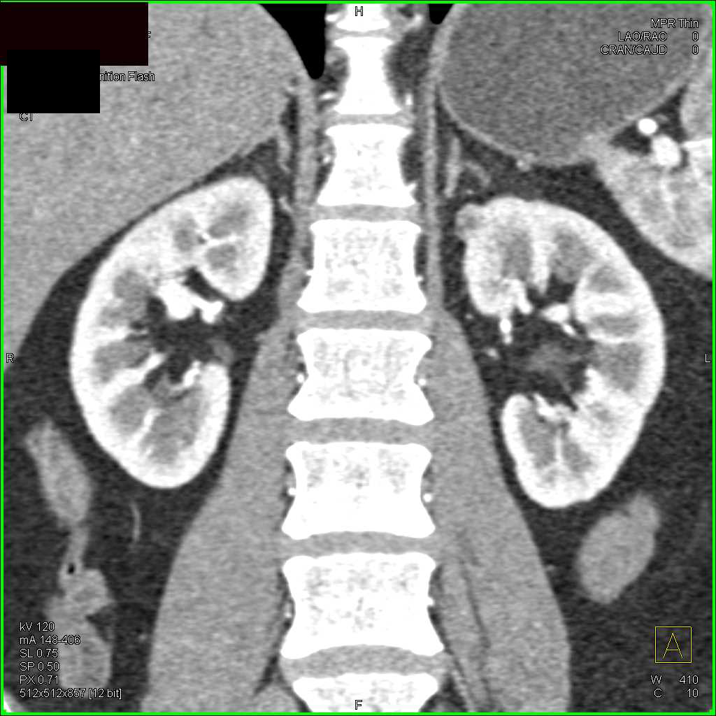 1cm Renal Cell Carcinoma Upper Pole Left Kidney - CTisus CT Scan