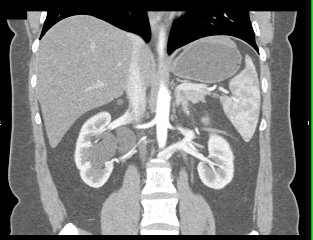 Right Hydronephrosis due to Crossing Vessel (lower pole renal artery) - CTisus CT Scan