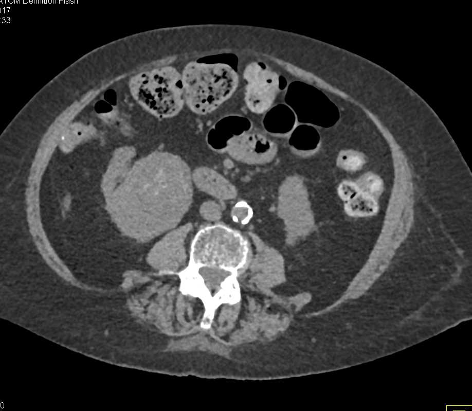 Papillary Renal Cell carcinoma Right Kidney - CTisus CT Scan