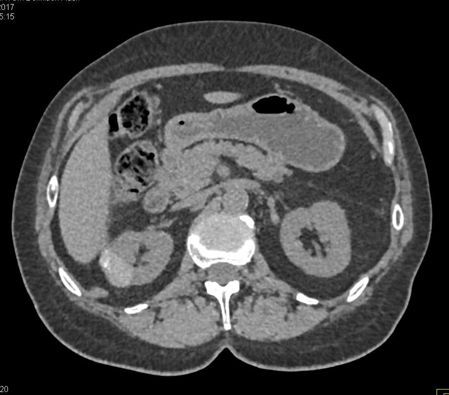 High Density Right Renal Cyst - CTisus CT Scan