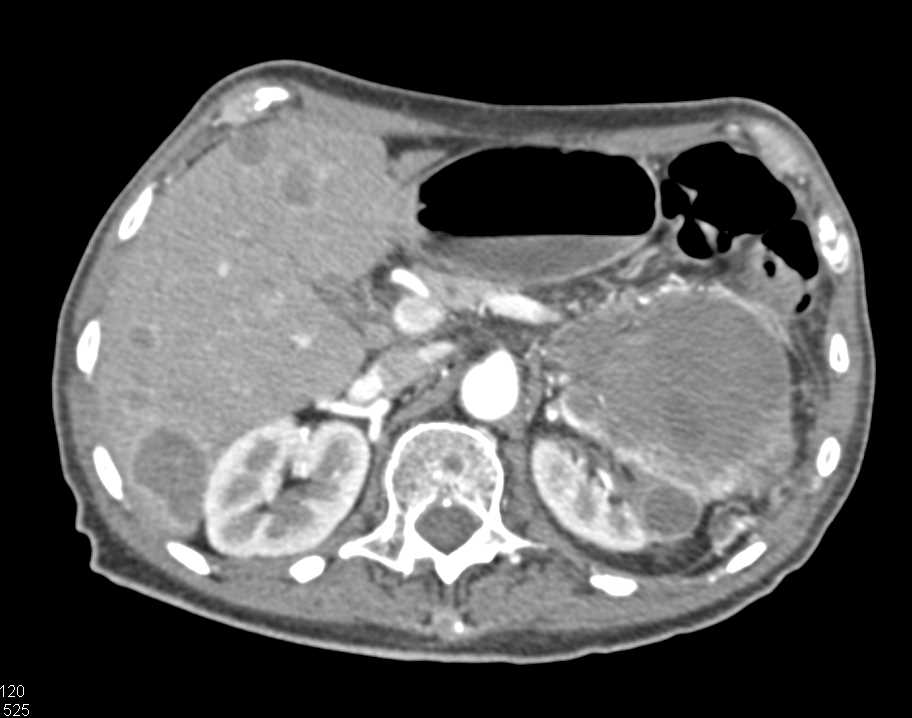 Cystic Renal Cell Carcinoma with Liver Metastases - CTisus CT Scan