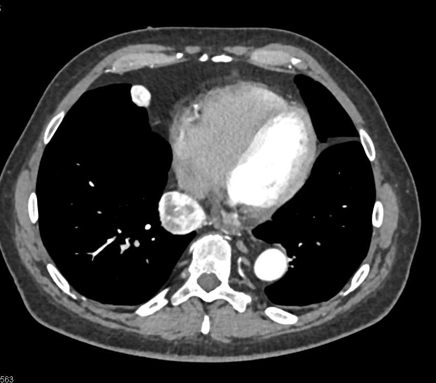 Metastatic Renal Cell Carcinoma to the Pancreas , Sacrum and Adenopathy - CTisus CT Scan