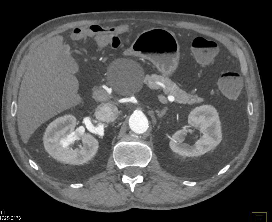 AV Fistulae Right Kidney with Cinematic Rendering - CTisus CT Scan