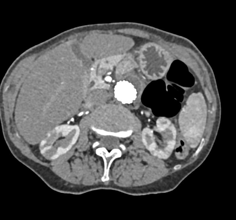 Multiple Small Renal Infarcts in Patient Post Abdominal Aortic Aneurysm (AAA) Repair - CTisus CT Scan