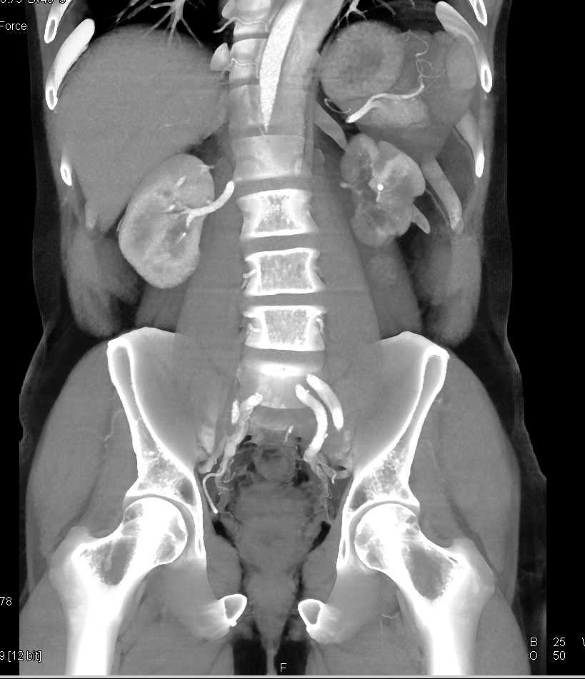 Stent in the Left Renal Artery with Renal Infarctions - CTisus CT Scan