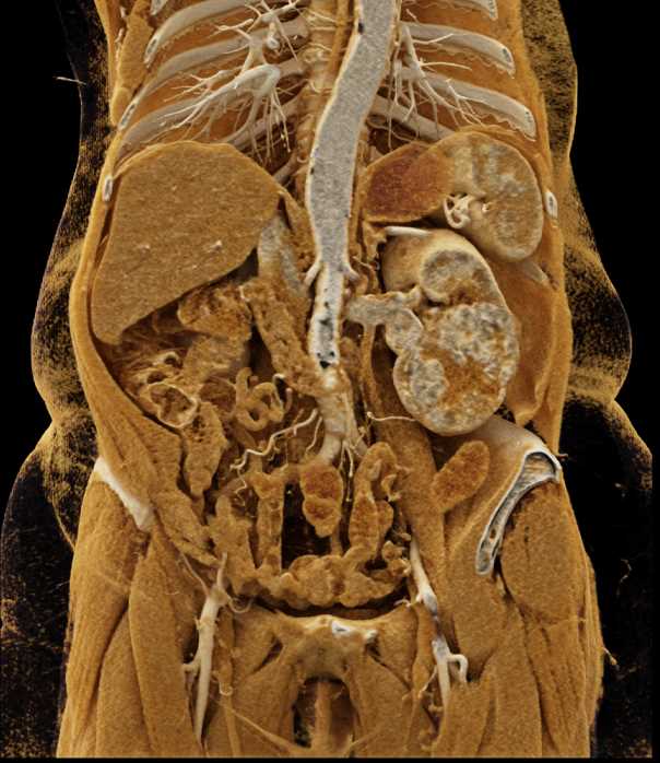 Clear Cell Carcinoma Left Kidney - CTisus CT Scan
