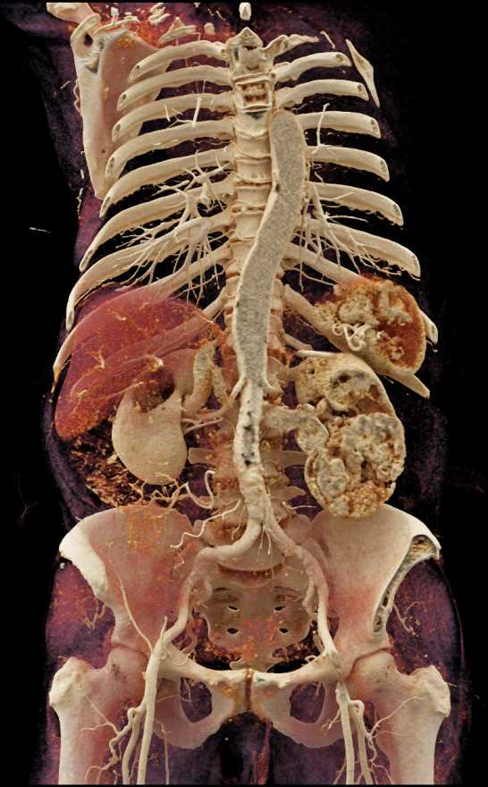 Clear Cell Carcinoma Left Kidney - CTisus CT Scan