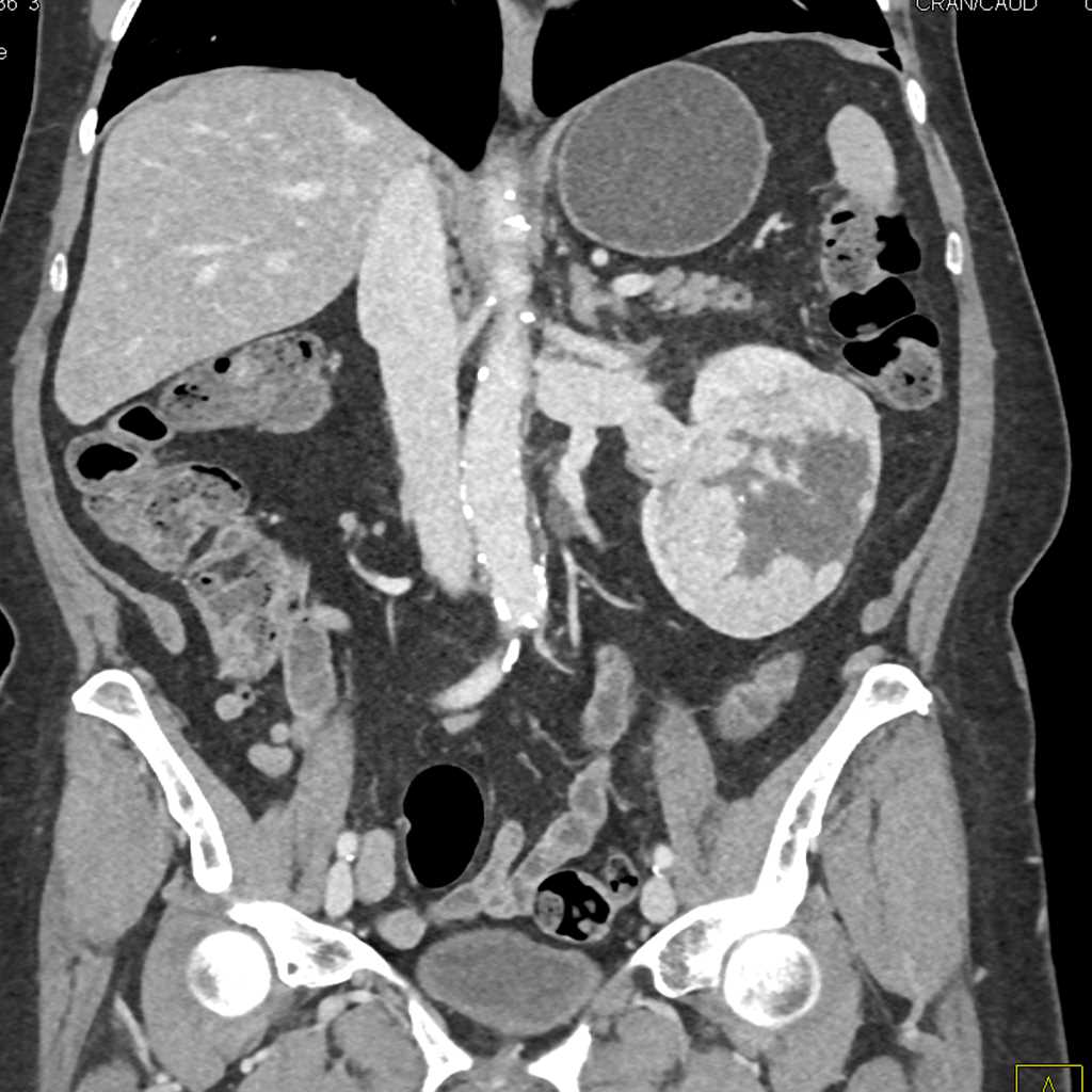 Clear Cell Renal Cell Carcinoma Invades the Renal Vein and the Inferior Vena Cava (IVC) - CTisus CT Scan