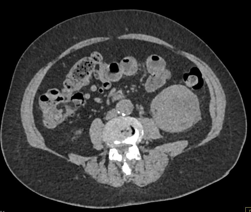 Clear Cell Renal Cell Carcinoma Invades the Renal Vein and the Inferior Vena Cava (IVC) - CTisus CT Scan